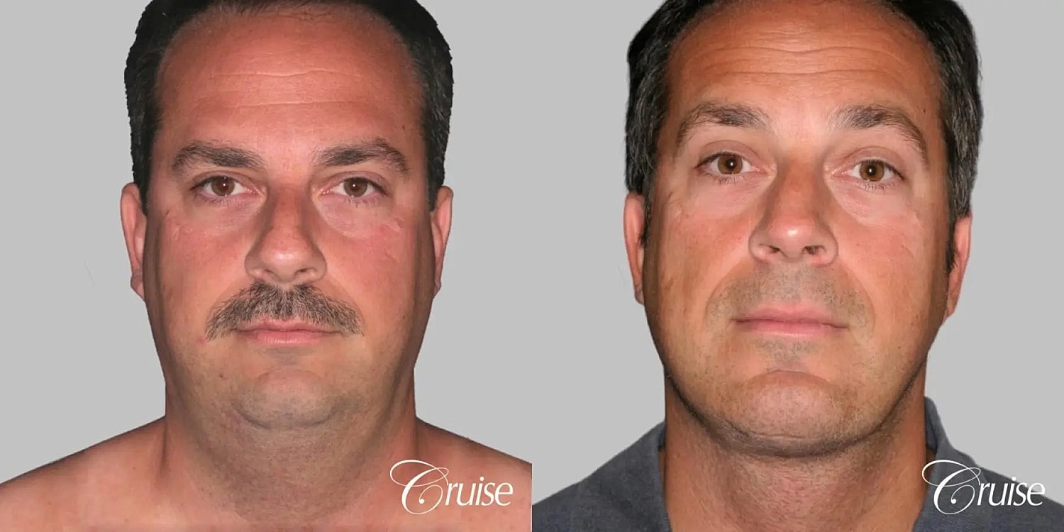 Face Lift Before & After