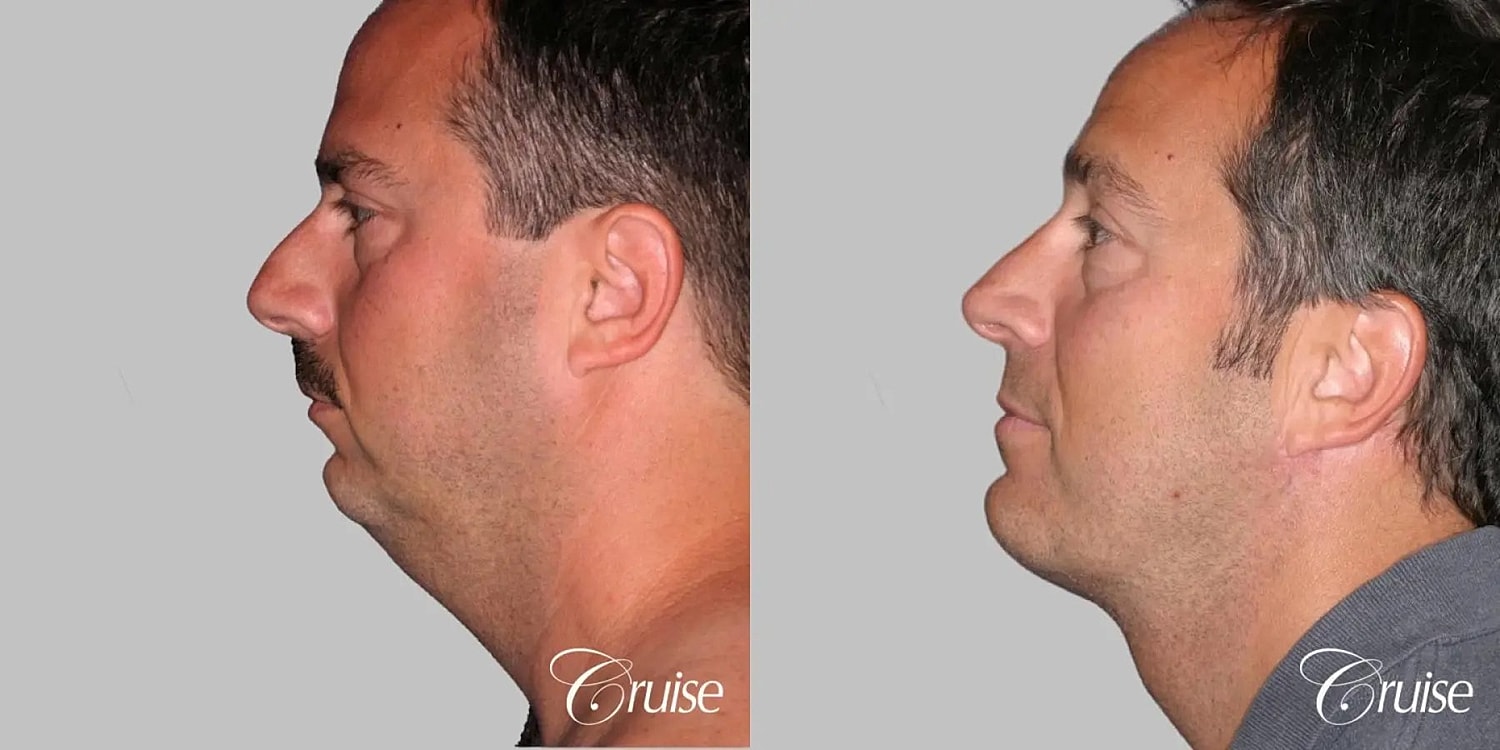 Face Lift Before & After