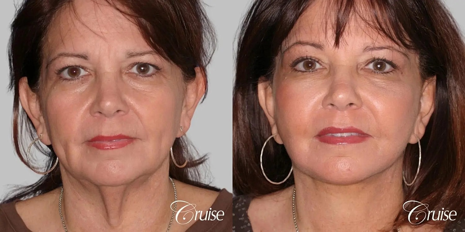 Face Lift Before & After
