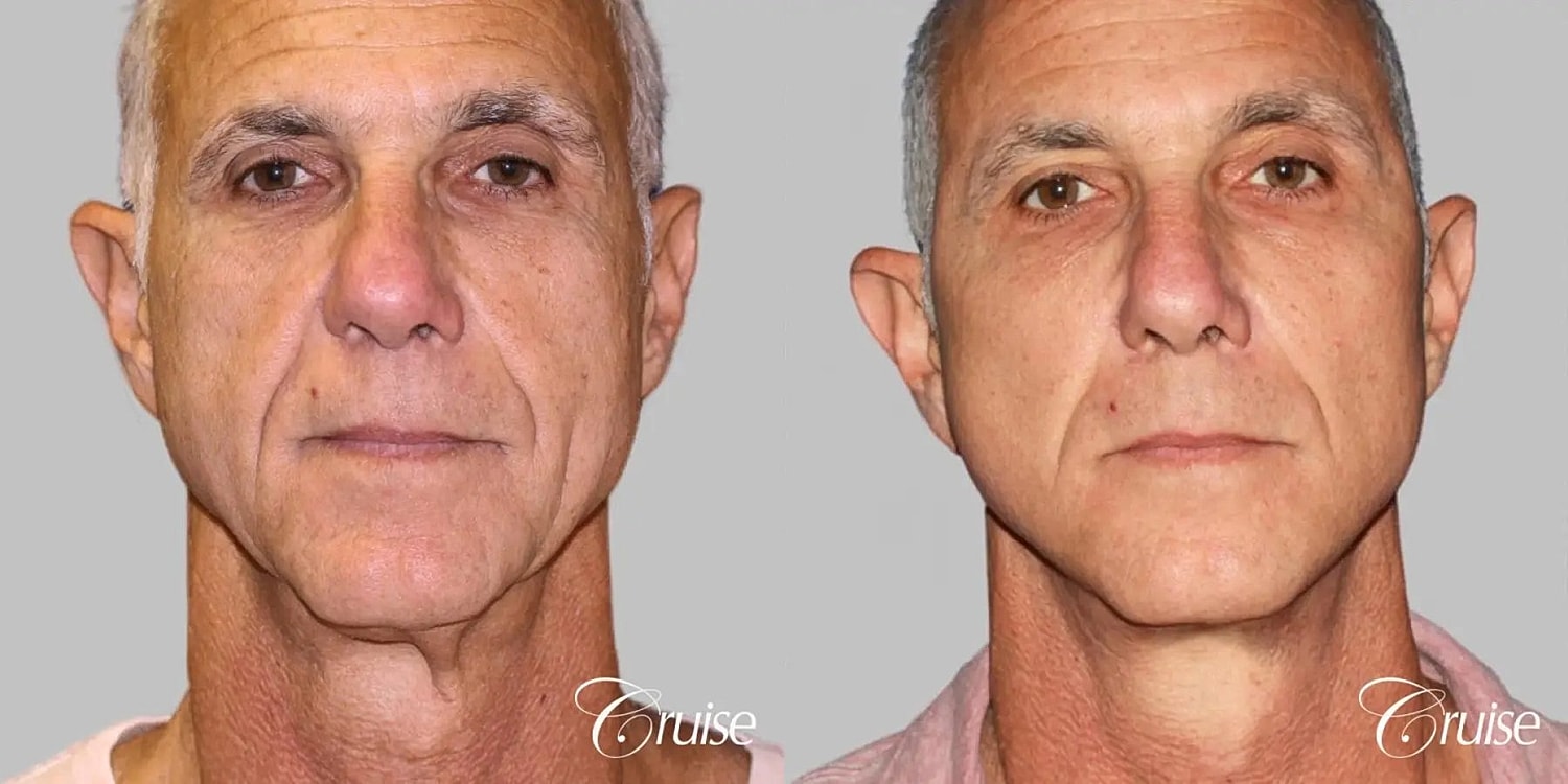 Face Lift Before & After