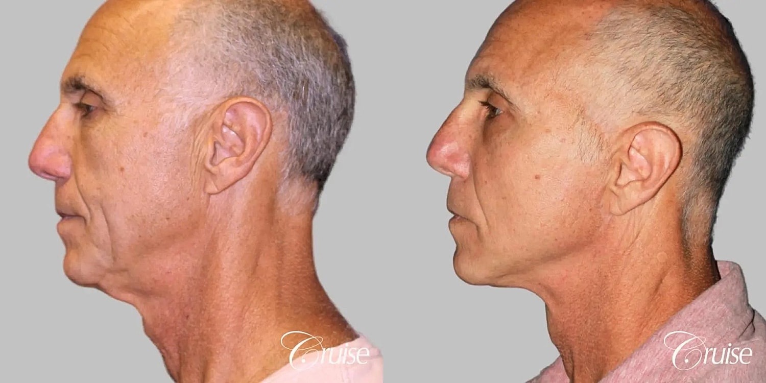 Face Lift Before & After