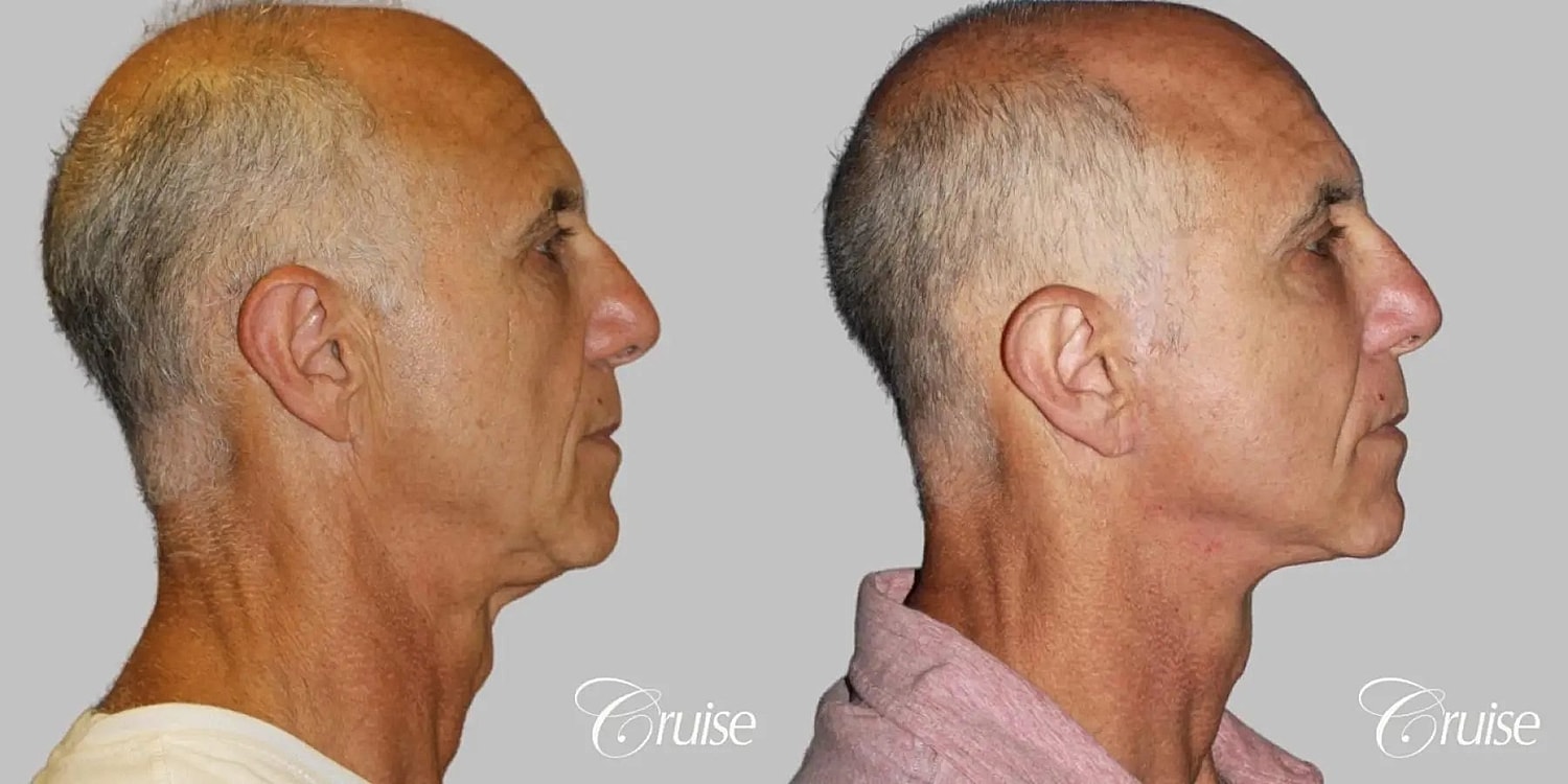 Face Lift Before & After