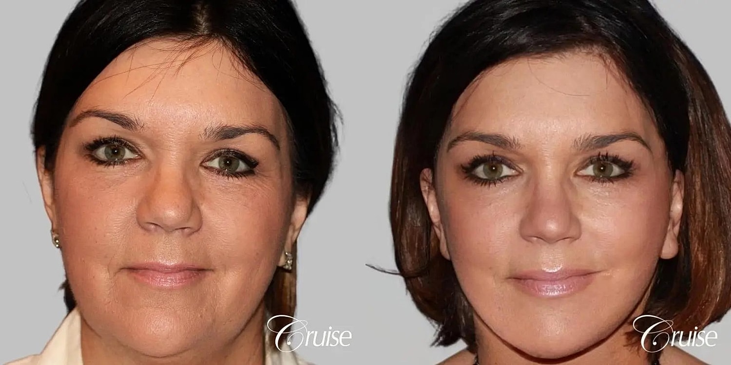Face Lift Before & After