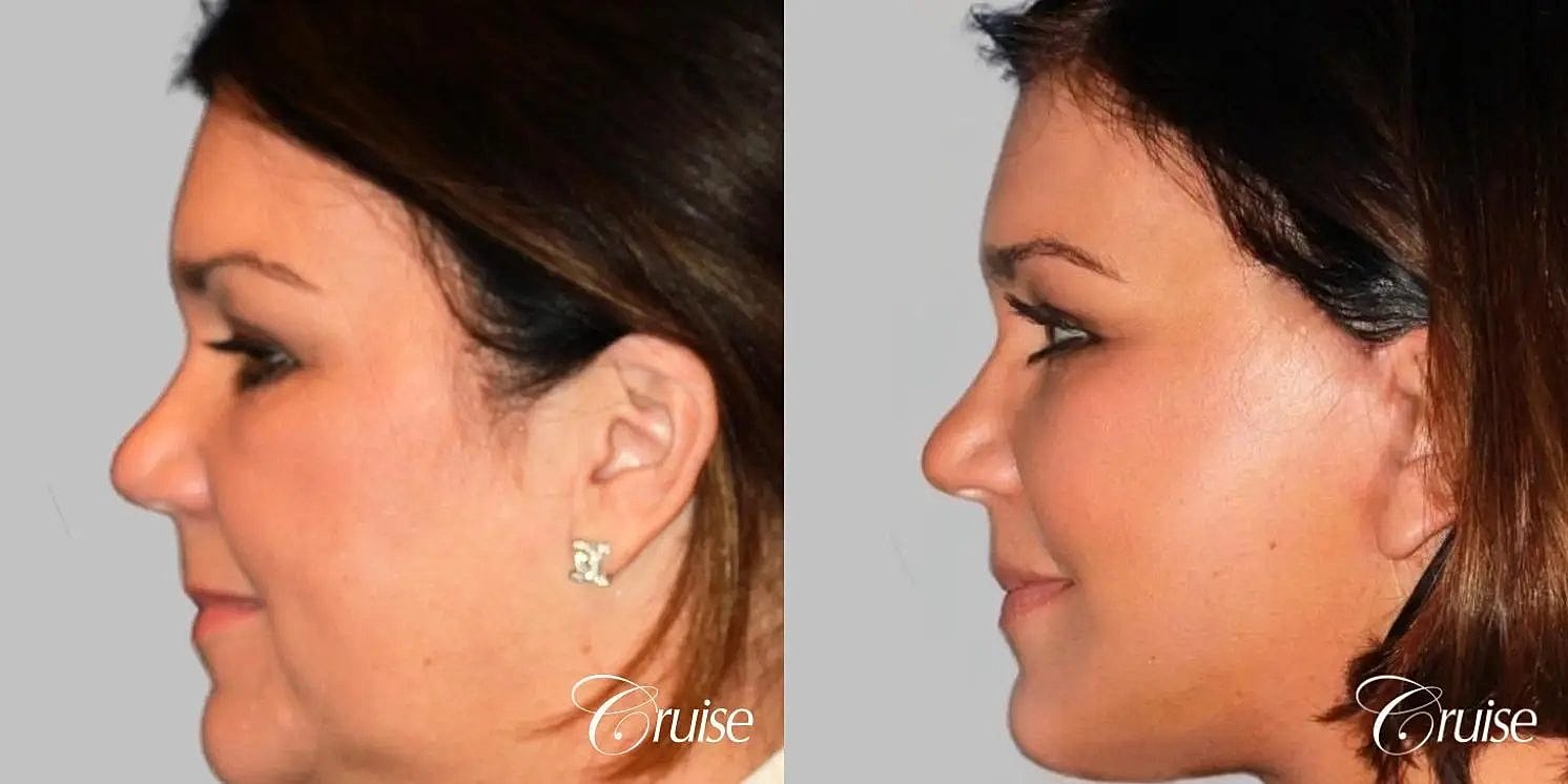Face Lift Before & After