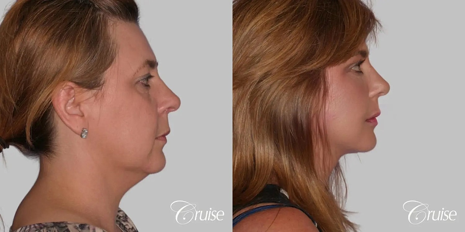 Face Lift Before & After