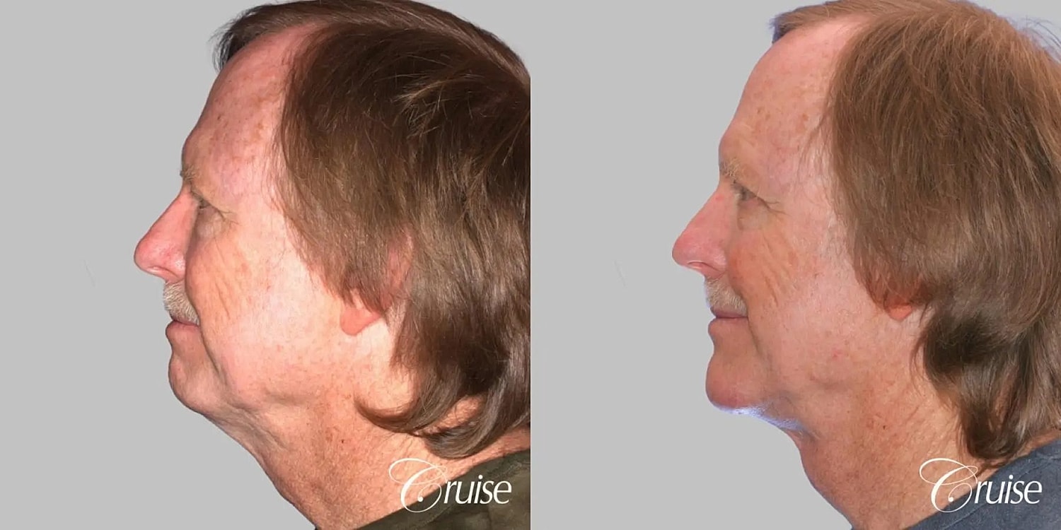 Face Lift Before & After