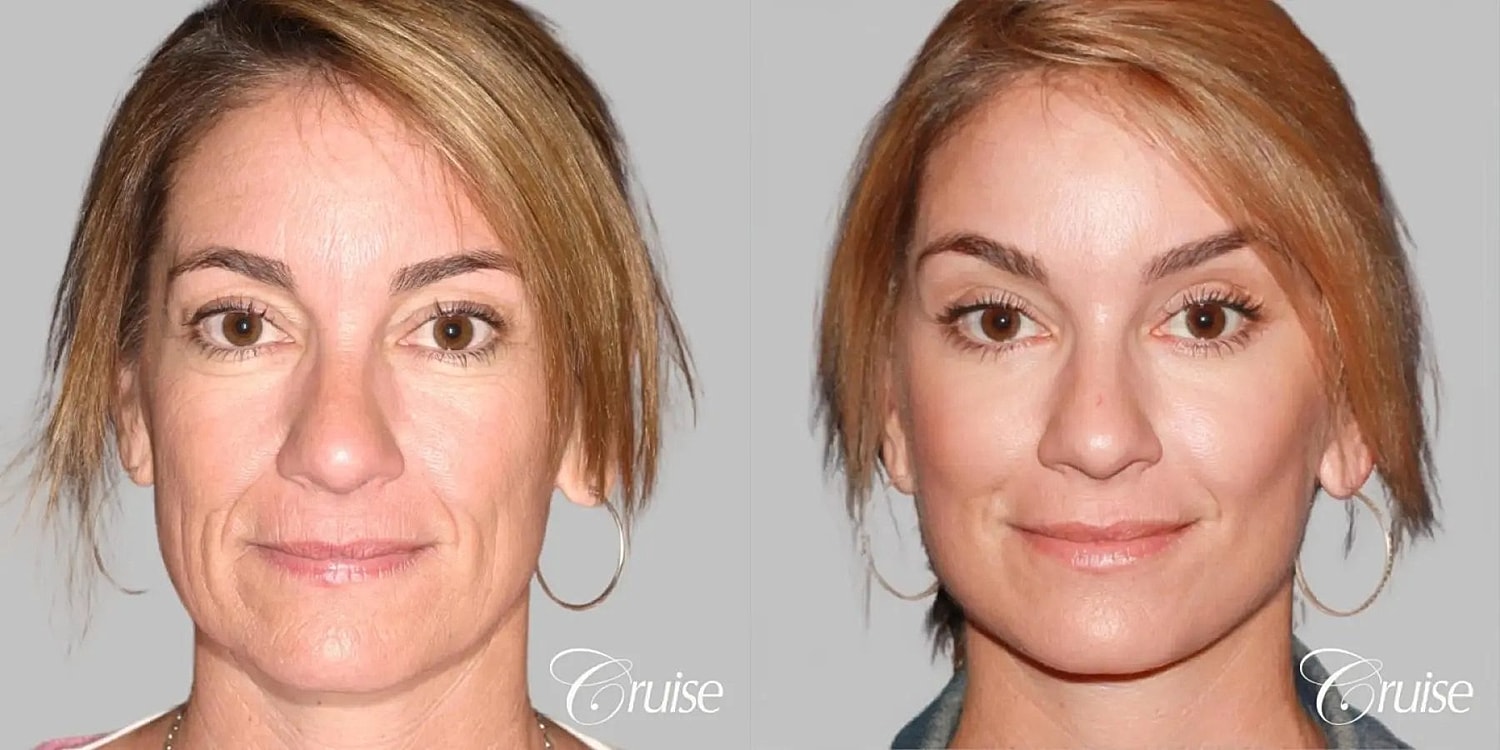 Face Lift Before & After