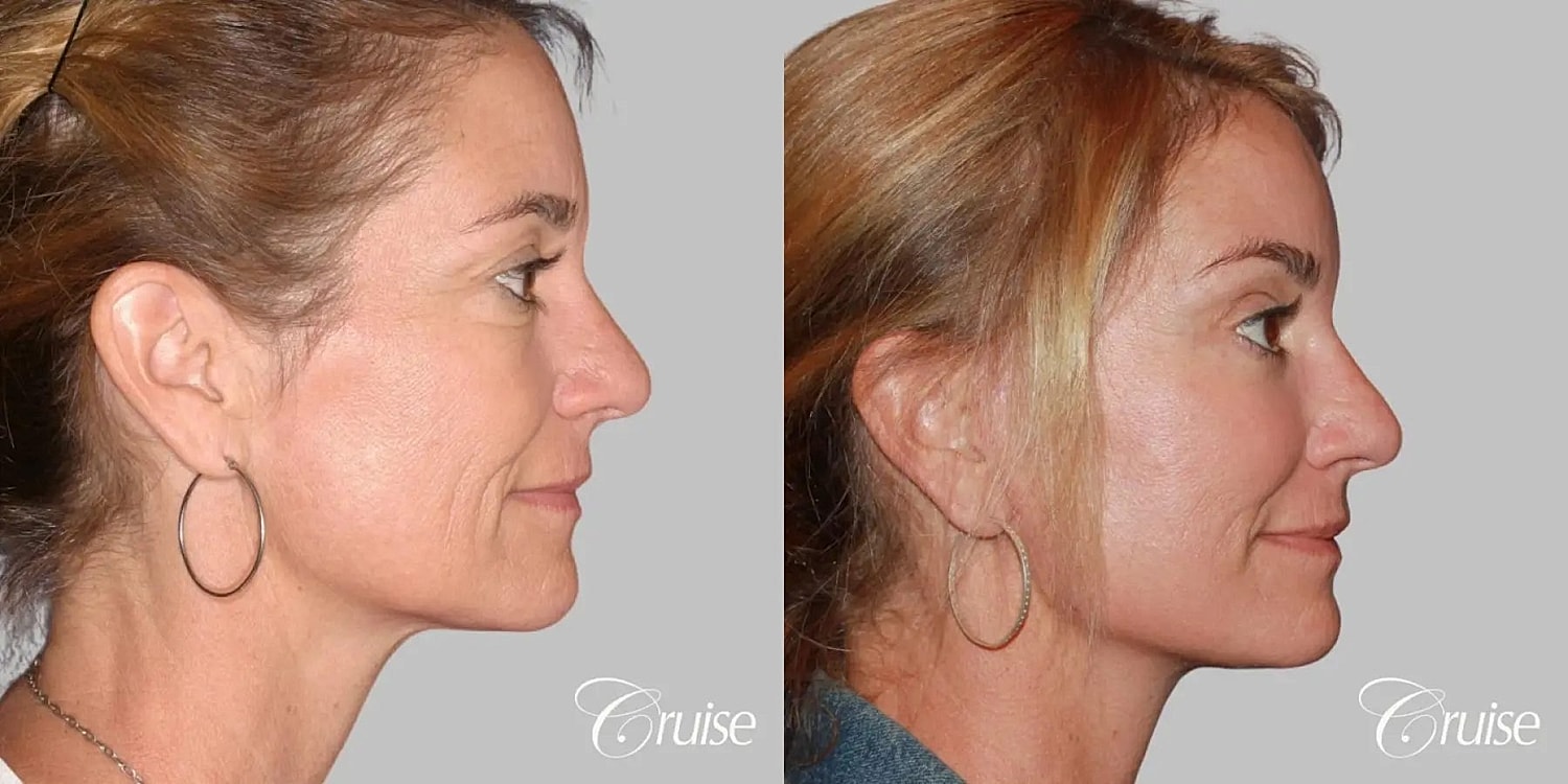Face Lift Before & After