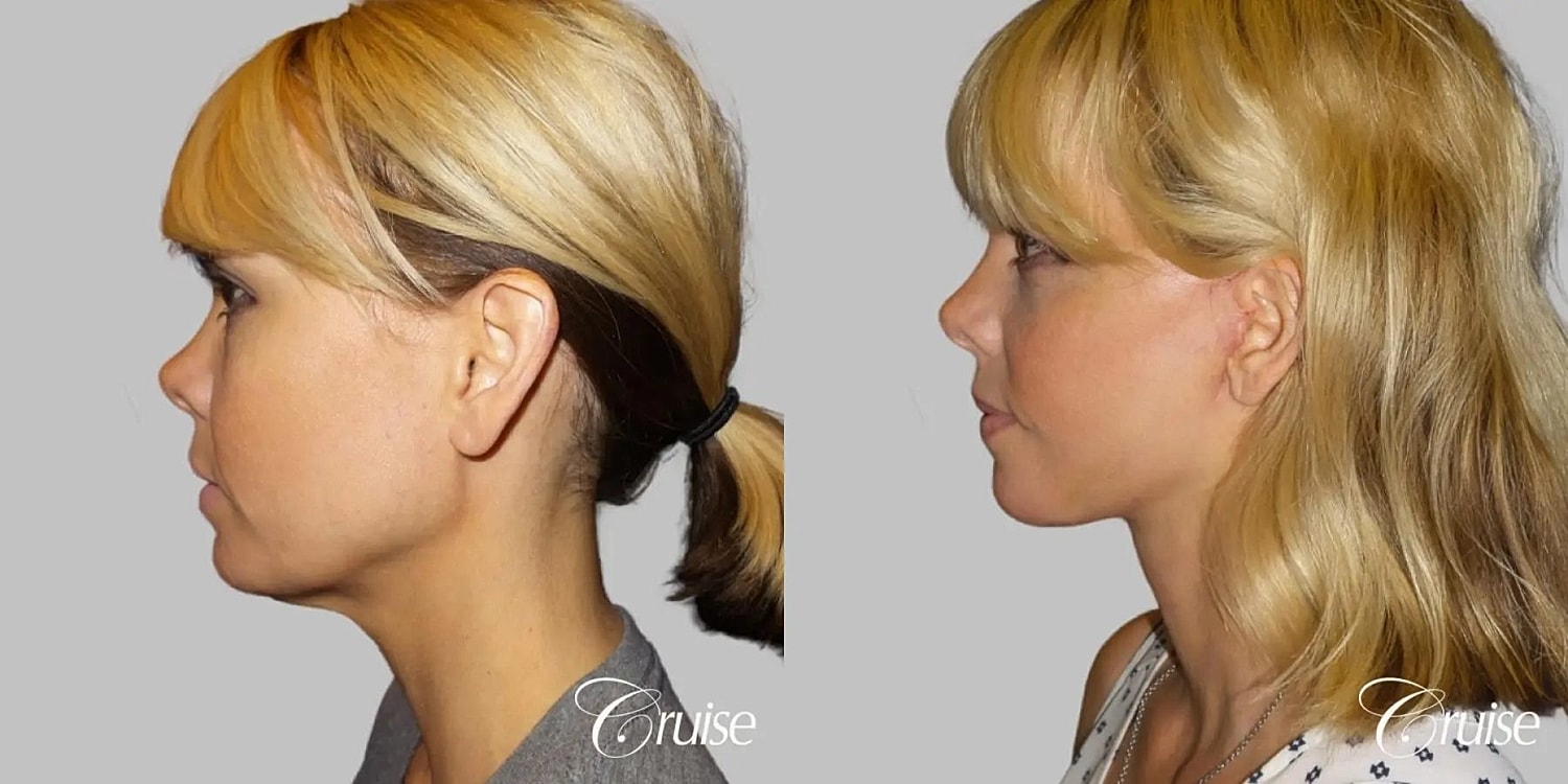 Face Lift Before & After