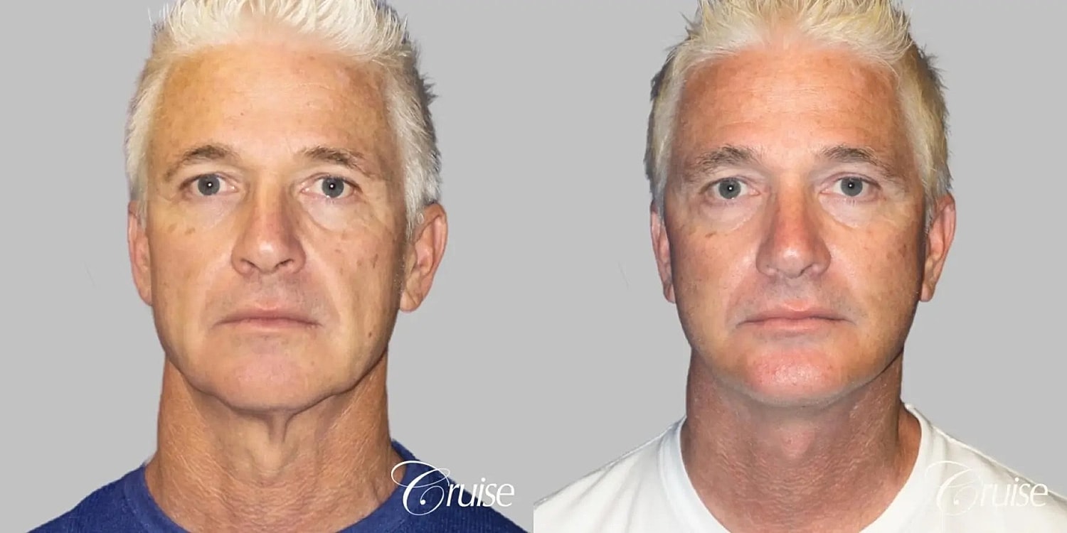 Face Lift Before & After