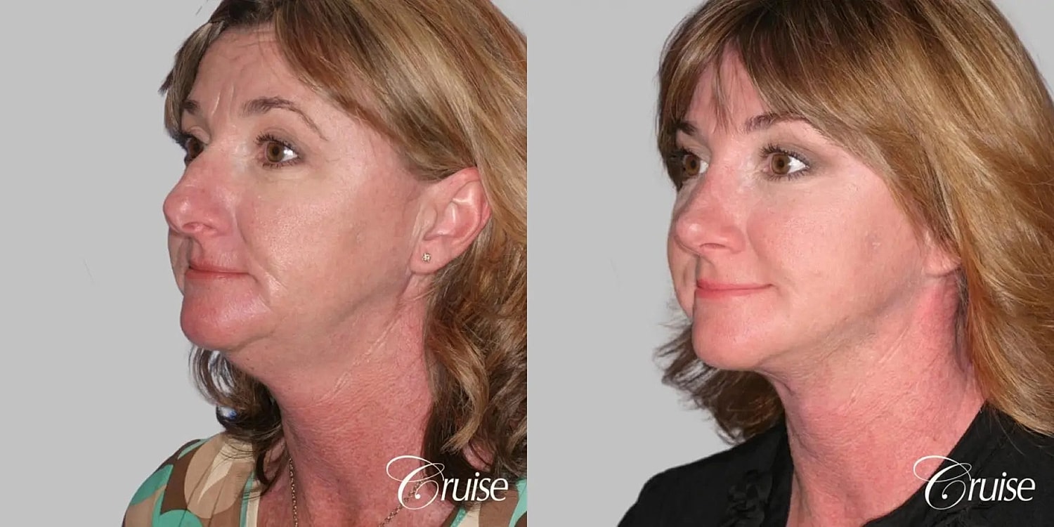 Face Lift Before & After