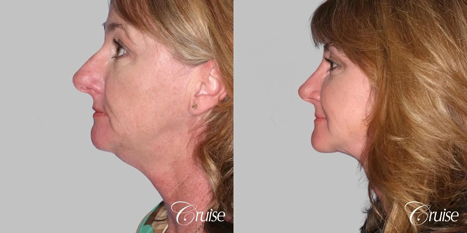 Face Lift Before & After