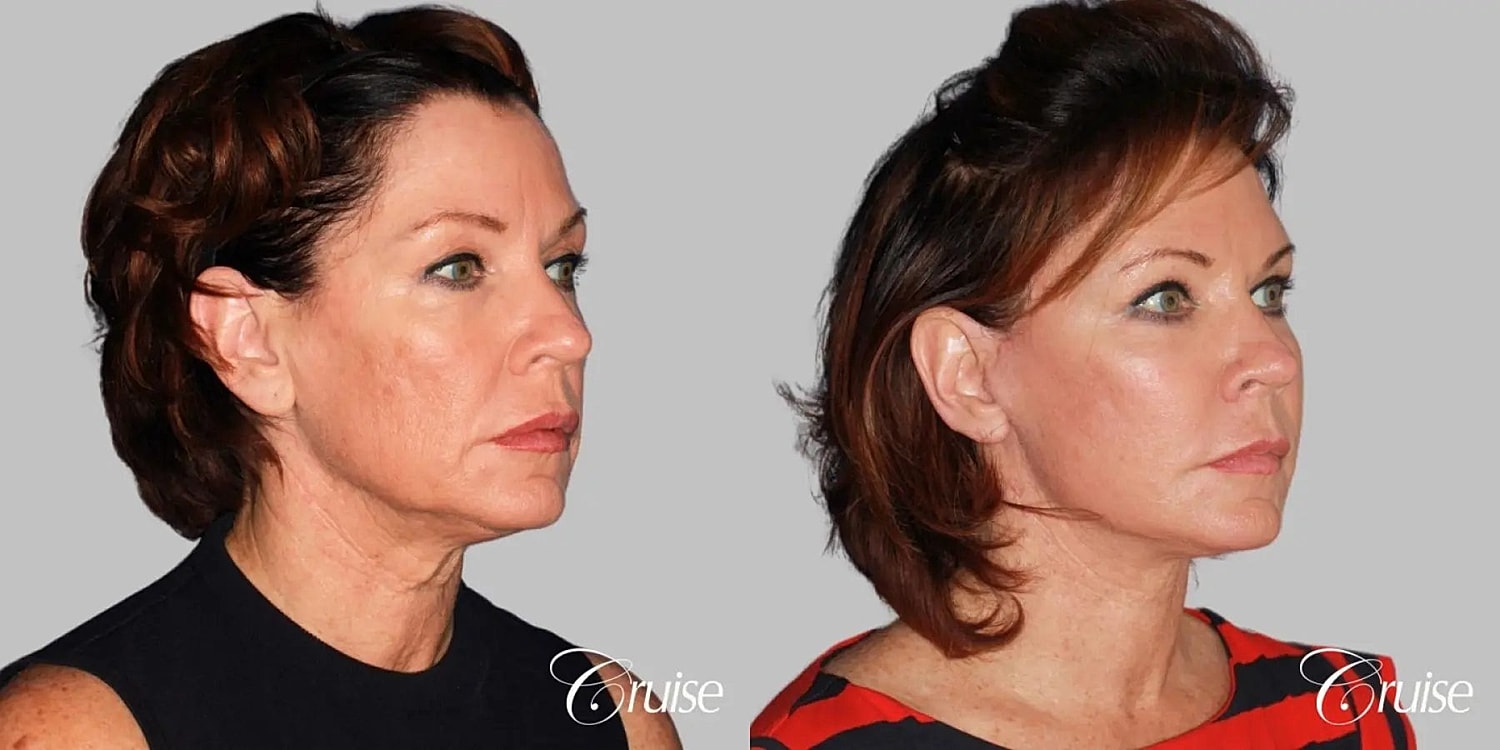 Face Lift Before & After