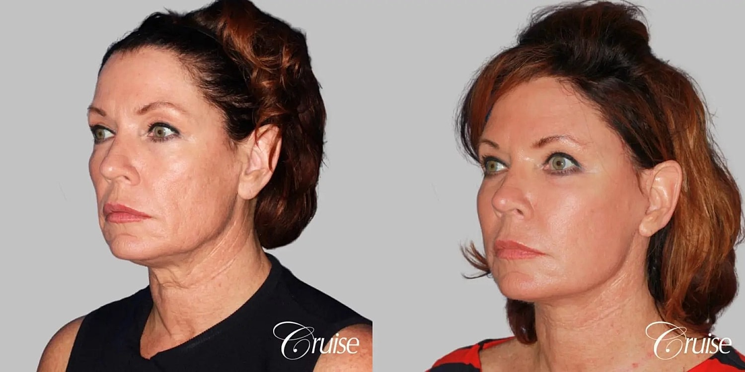 Face Lift Before & After
