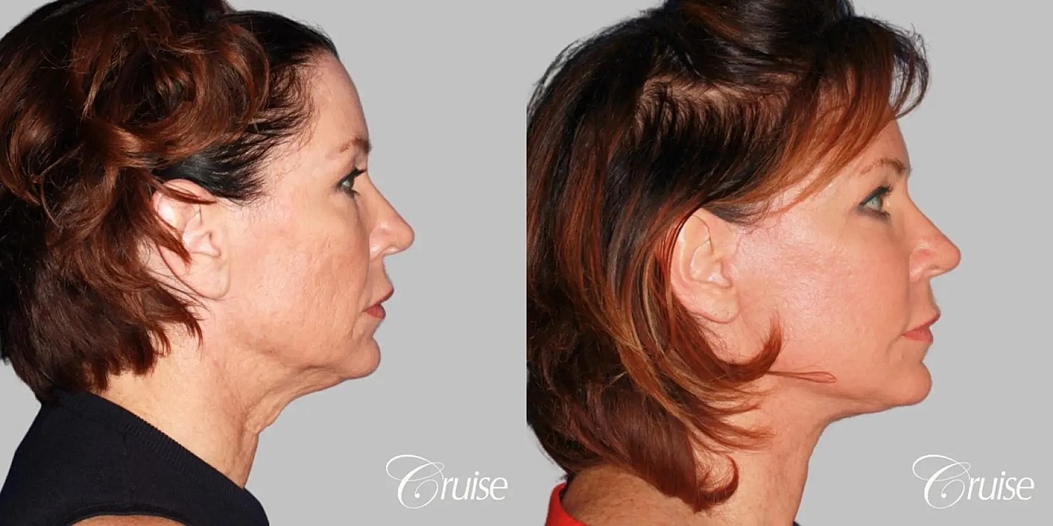 Face Lift Before & After