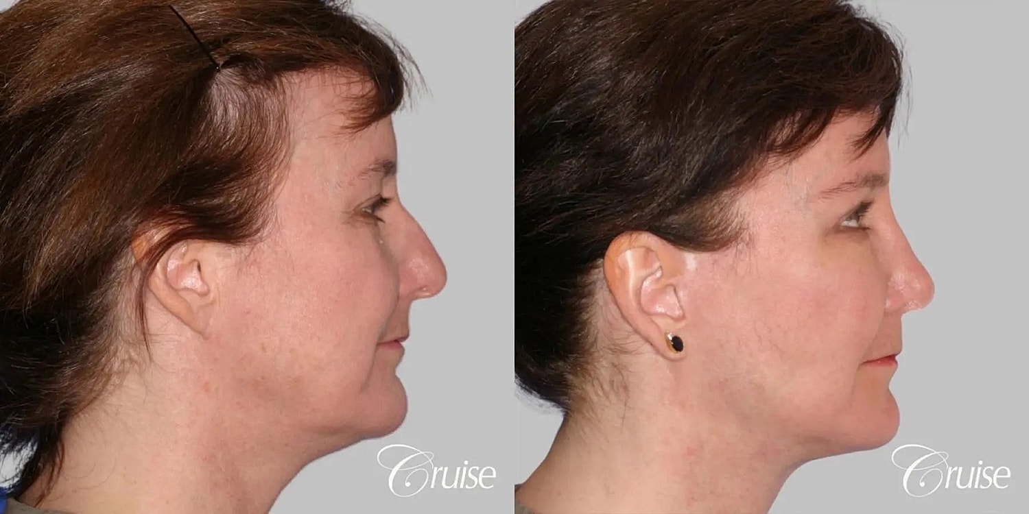 Face Lift Before & After