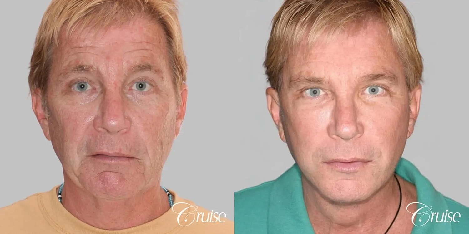 Face Lift Before & After