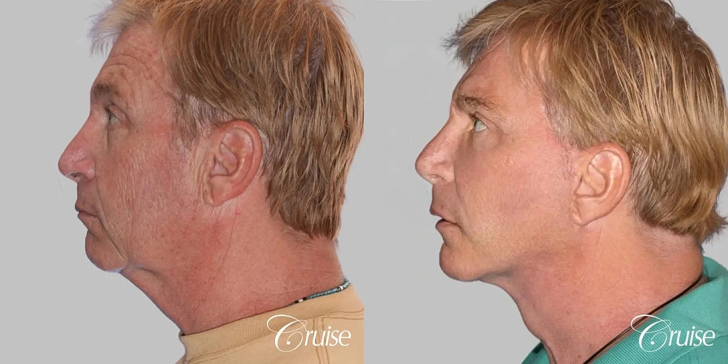 Face Lift Before & After