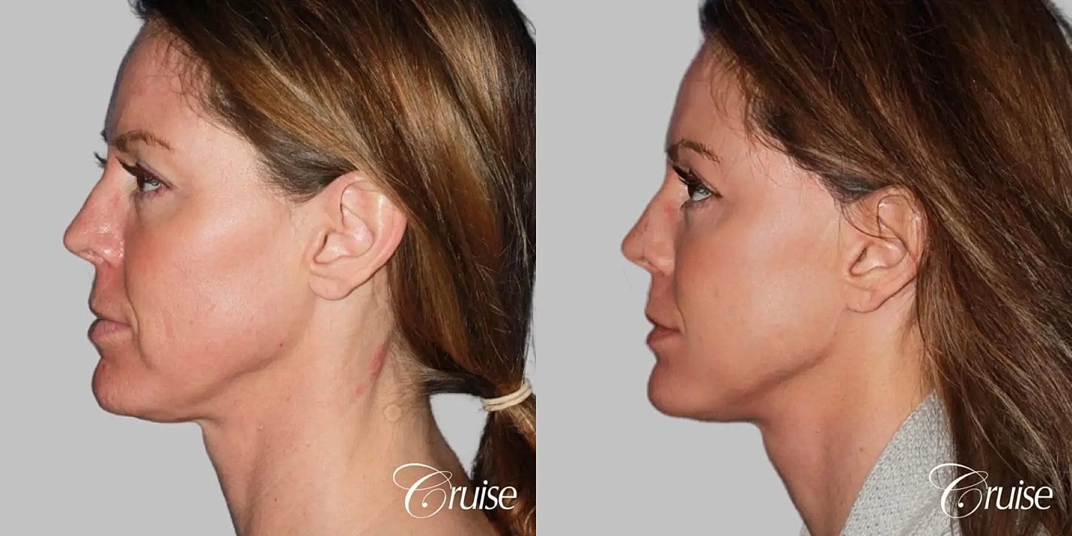Face Lift Before & After