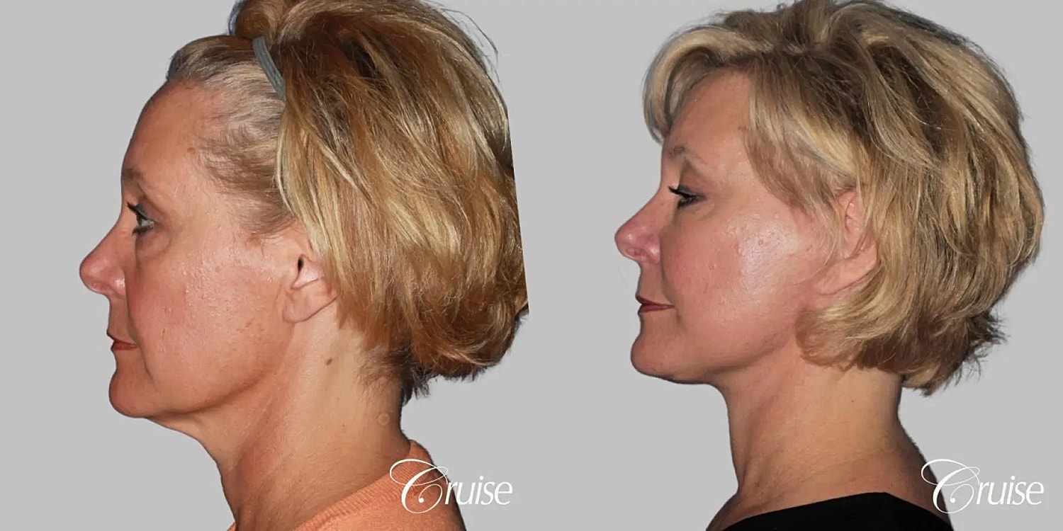 Face Lift Before & After