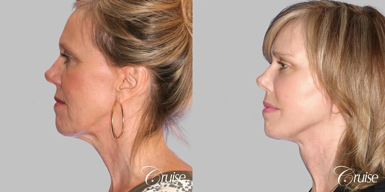 Face Lift Before & After