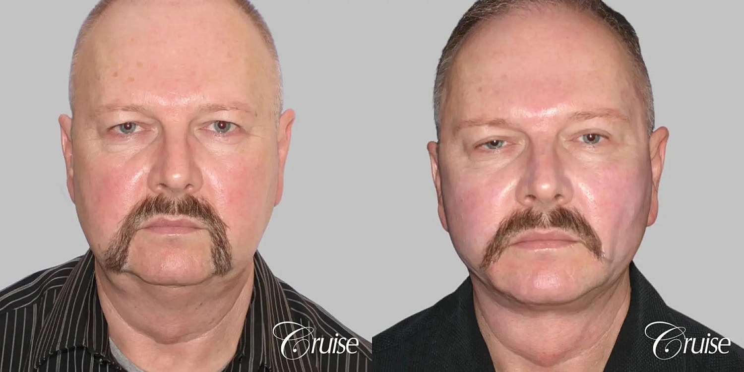 Face Lift Before & After