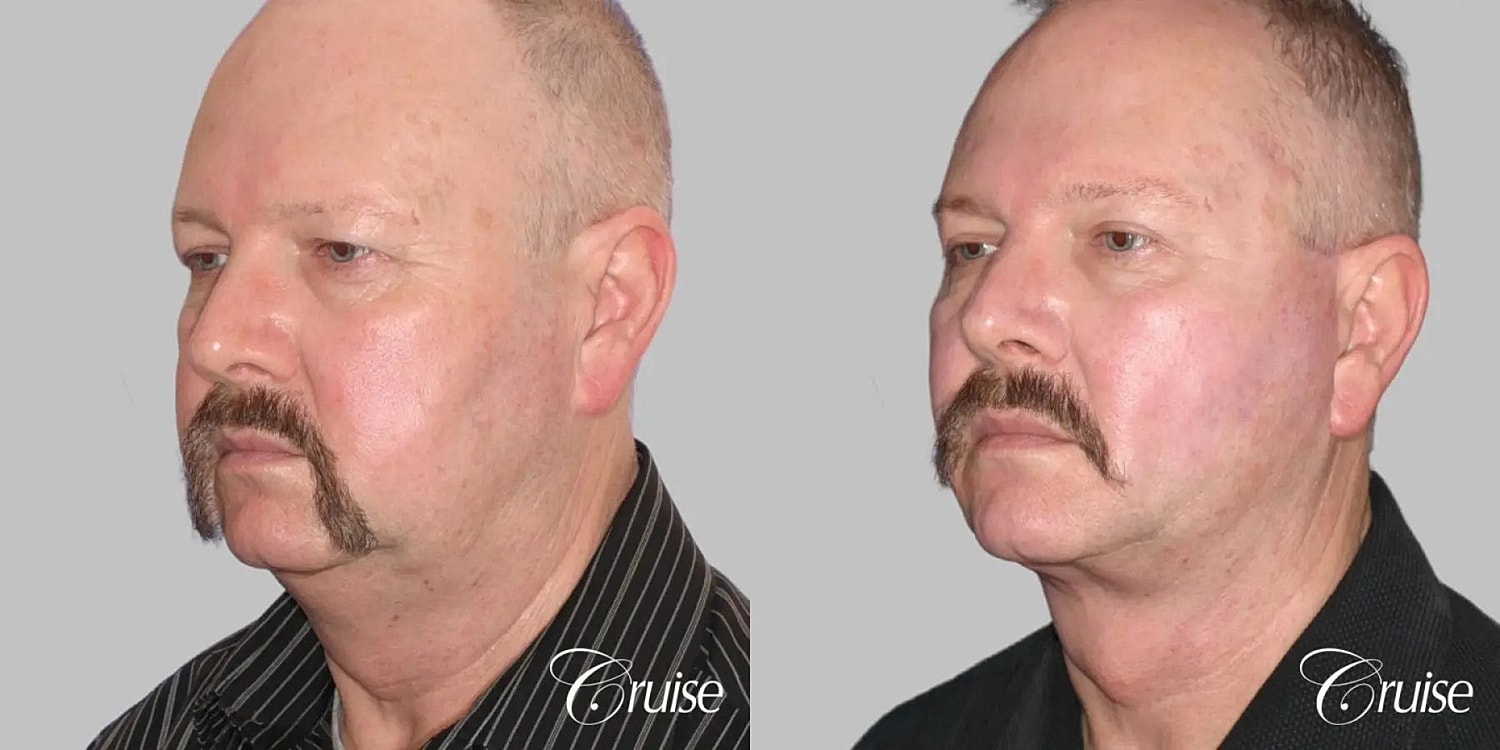 Face Lift Before & After