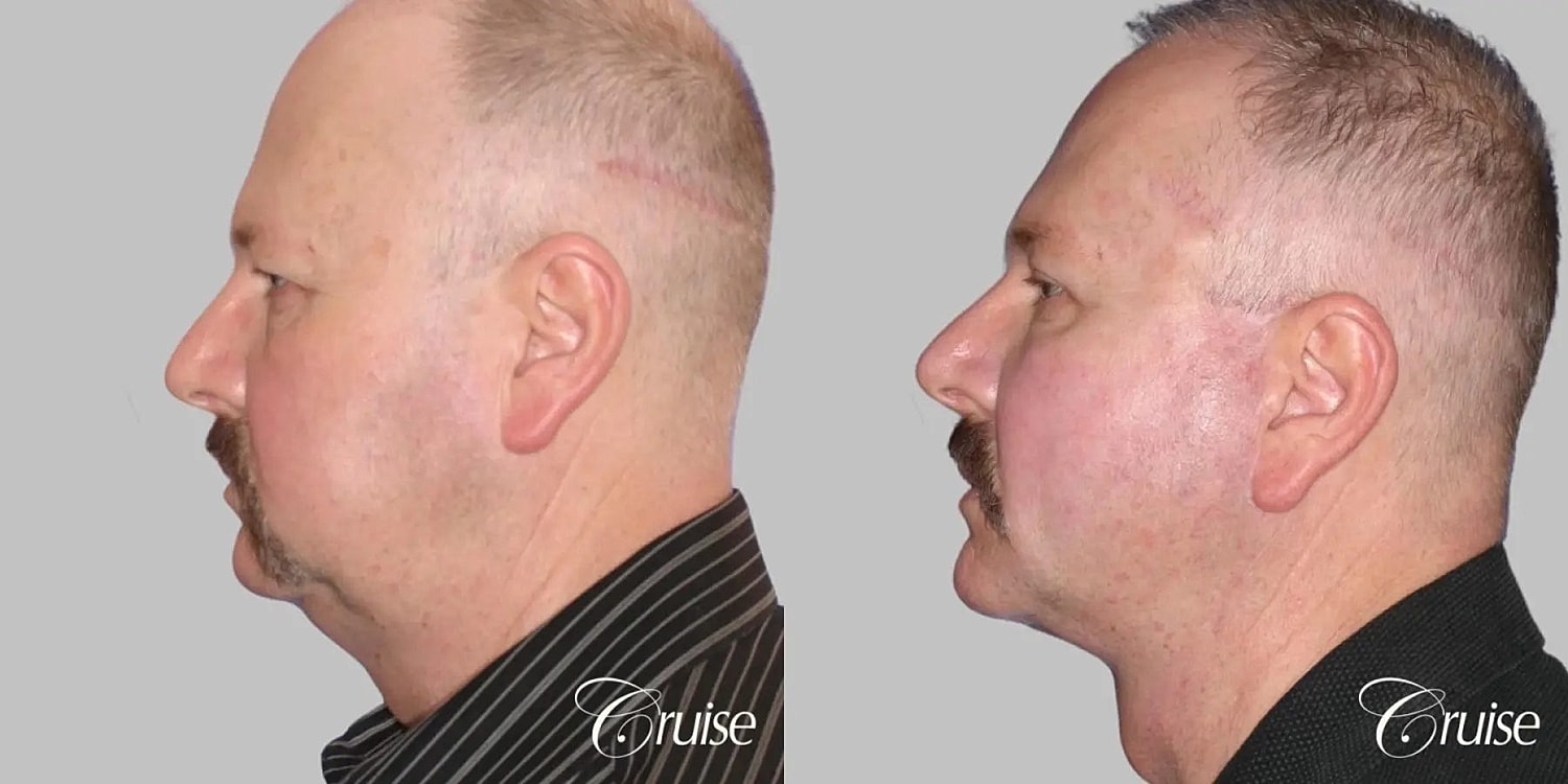 Face Lift Before & After