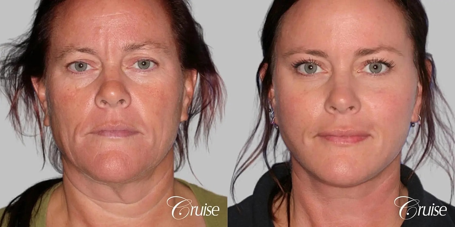 Face Lift Before & After