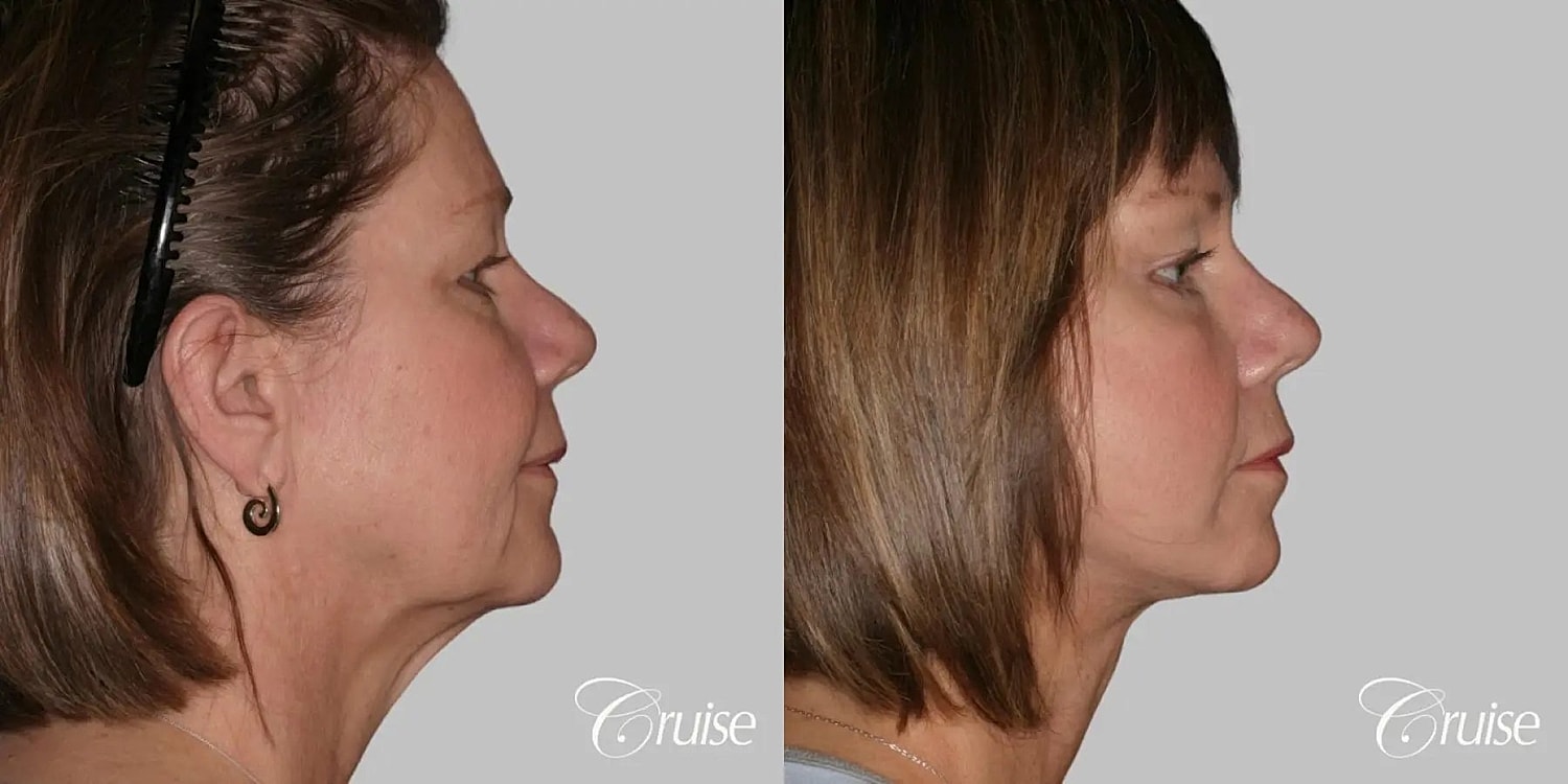 Face Lift Before & After