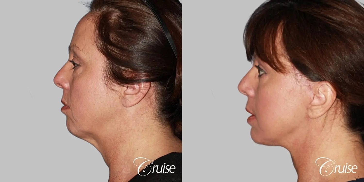 Face Lift Before & After