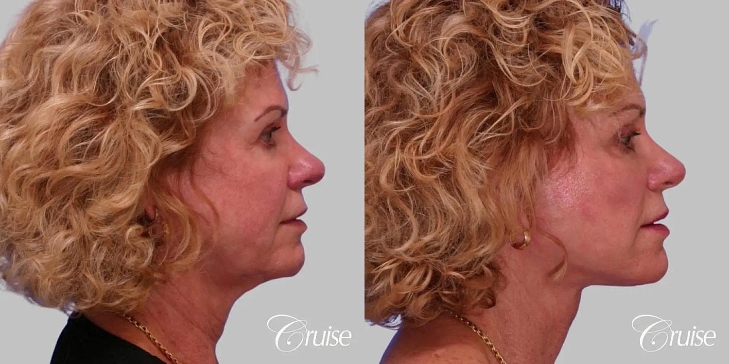 Face Lift Before & After