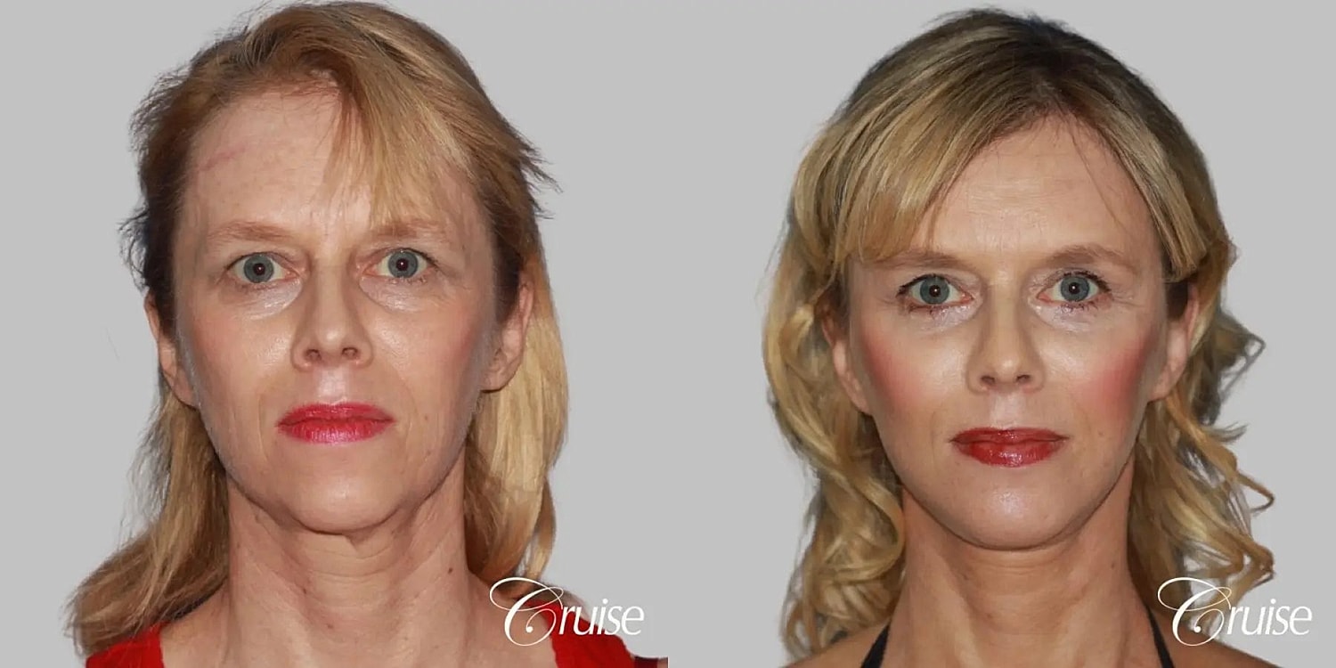 Face Lift Before & After