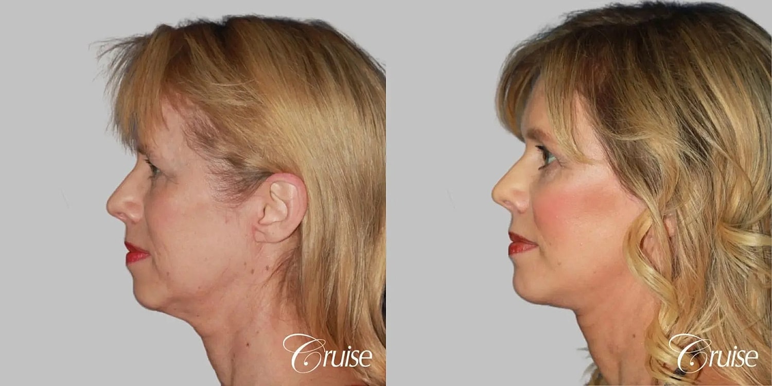 Face Lift Before & After