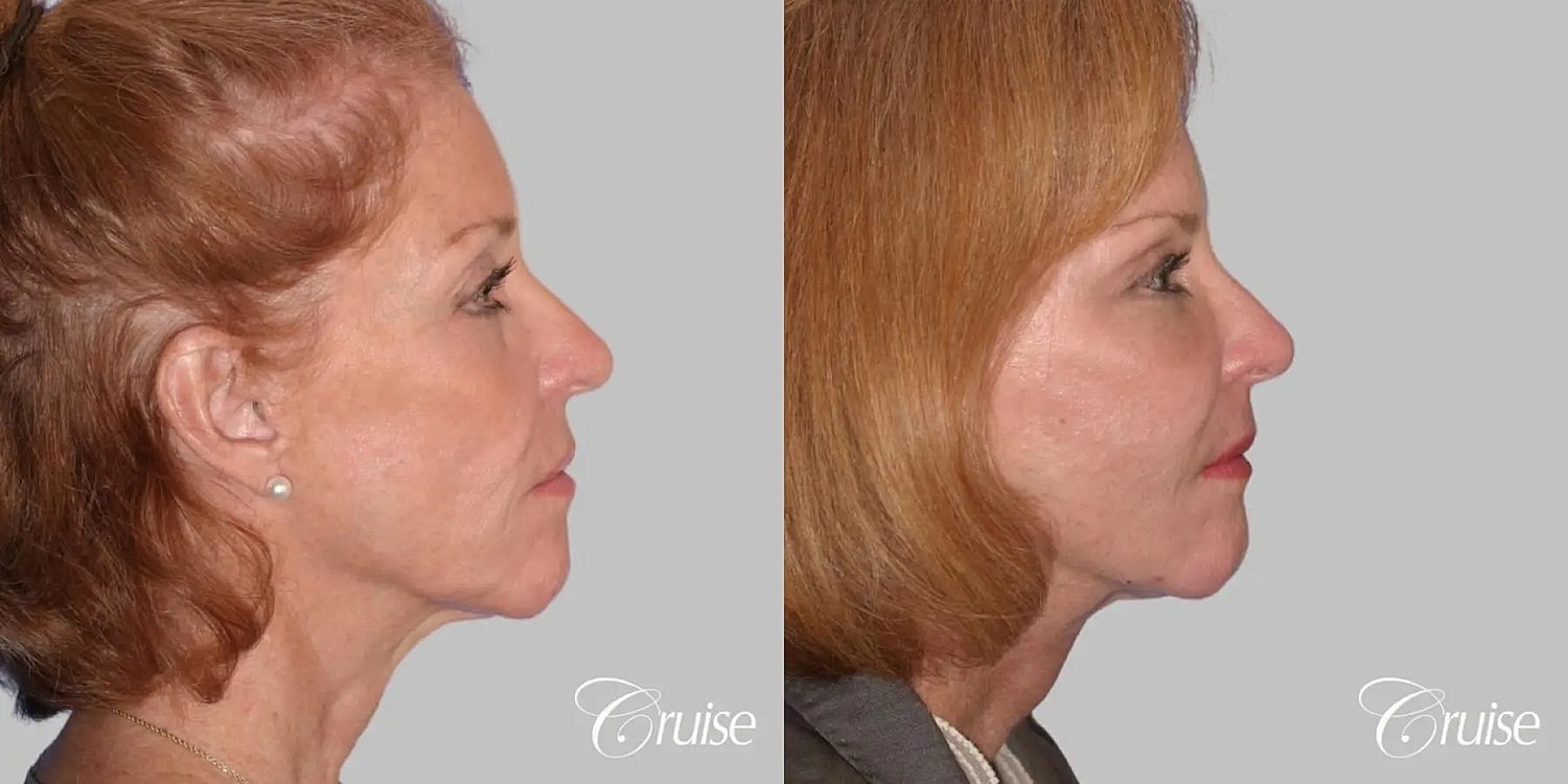 Face Lift Before & After