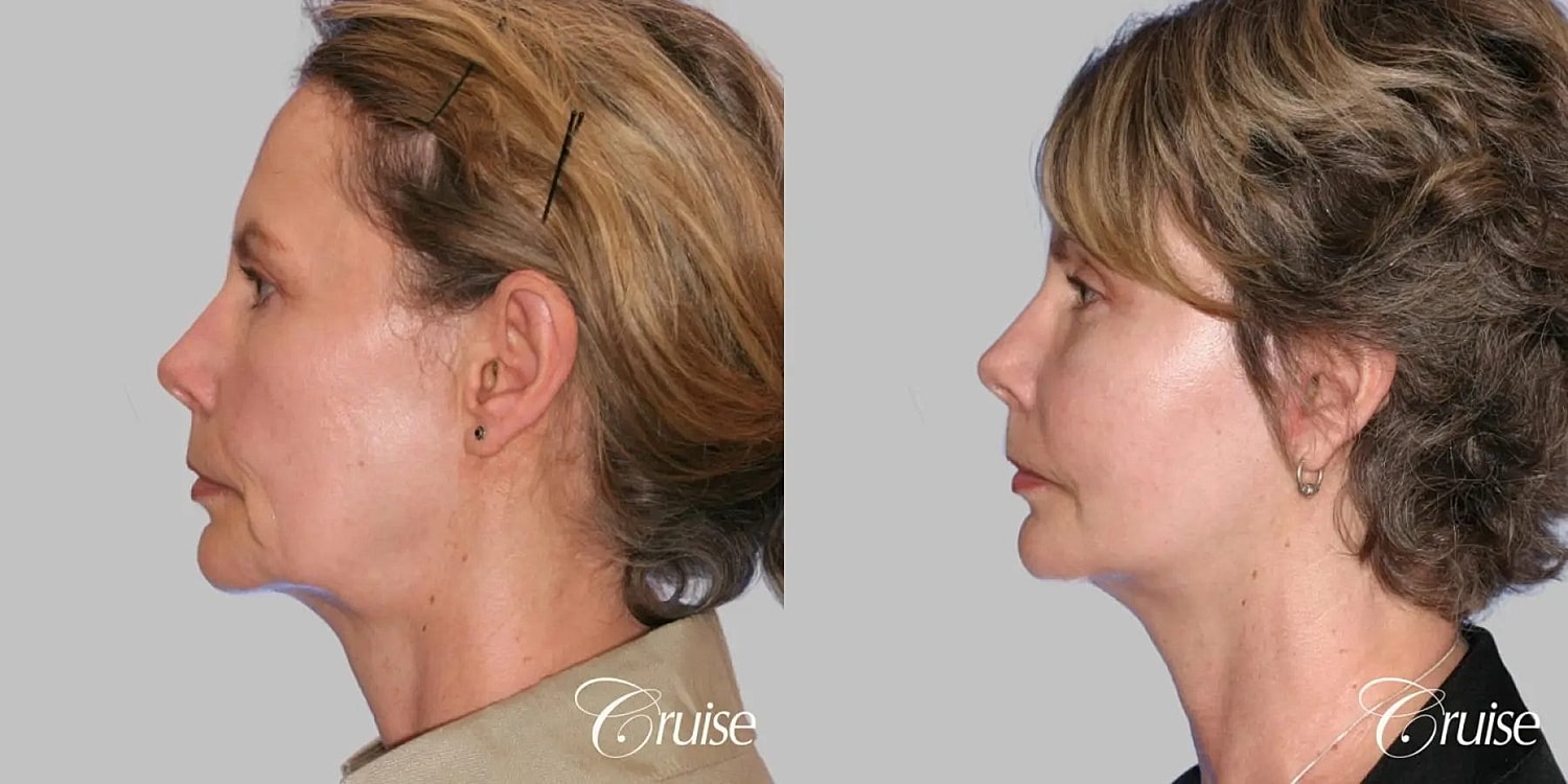 Face Lift Before & After