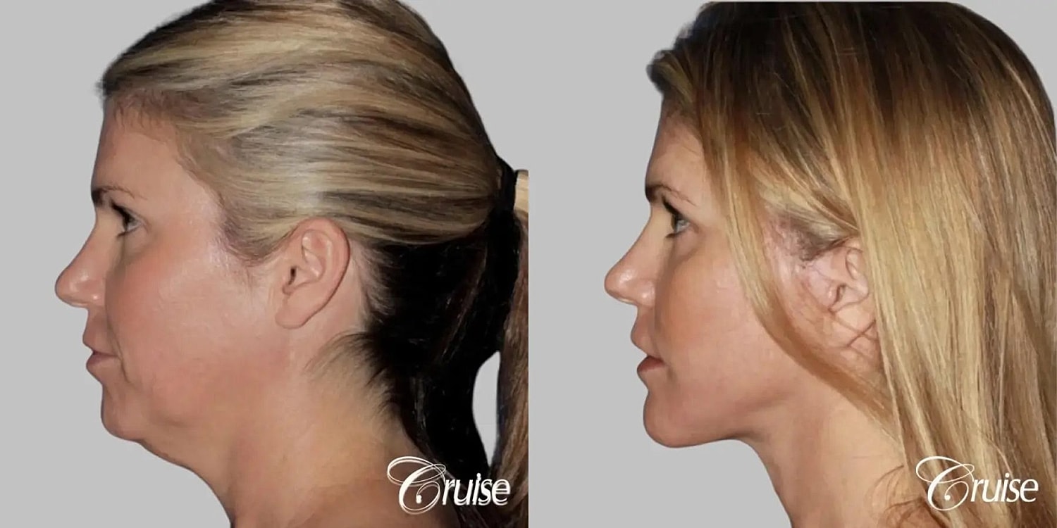 Face Lift Before & After