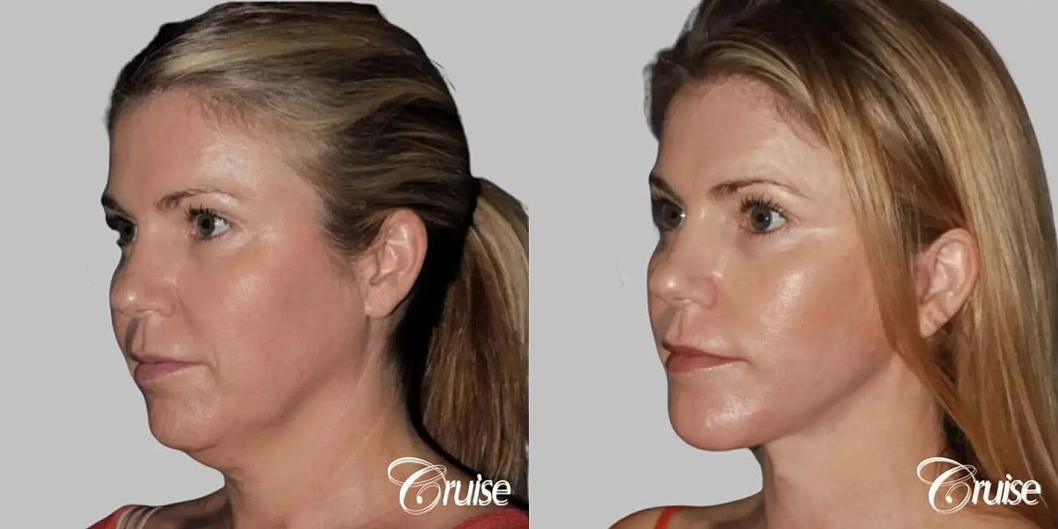 Face Lift Before & After