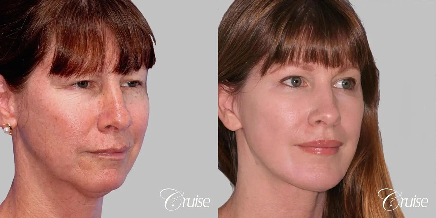 Face Lift Before & After