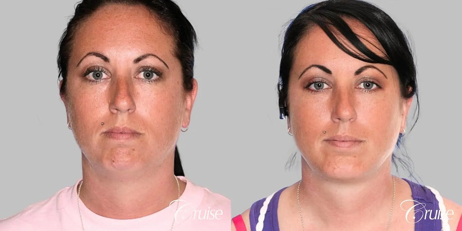 Face Lift Before & After
