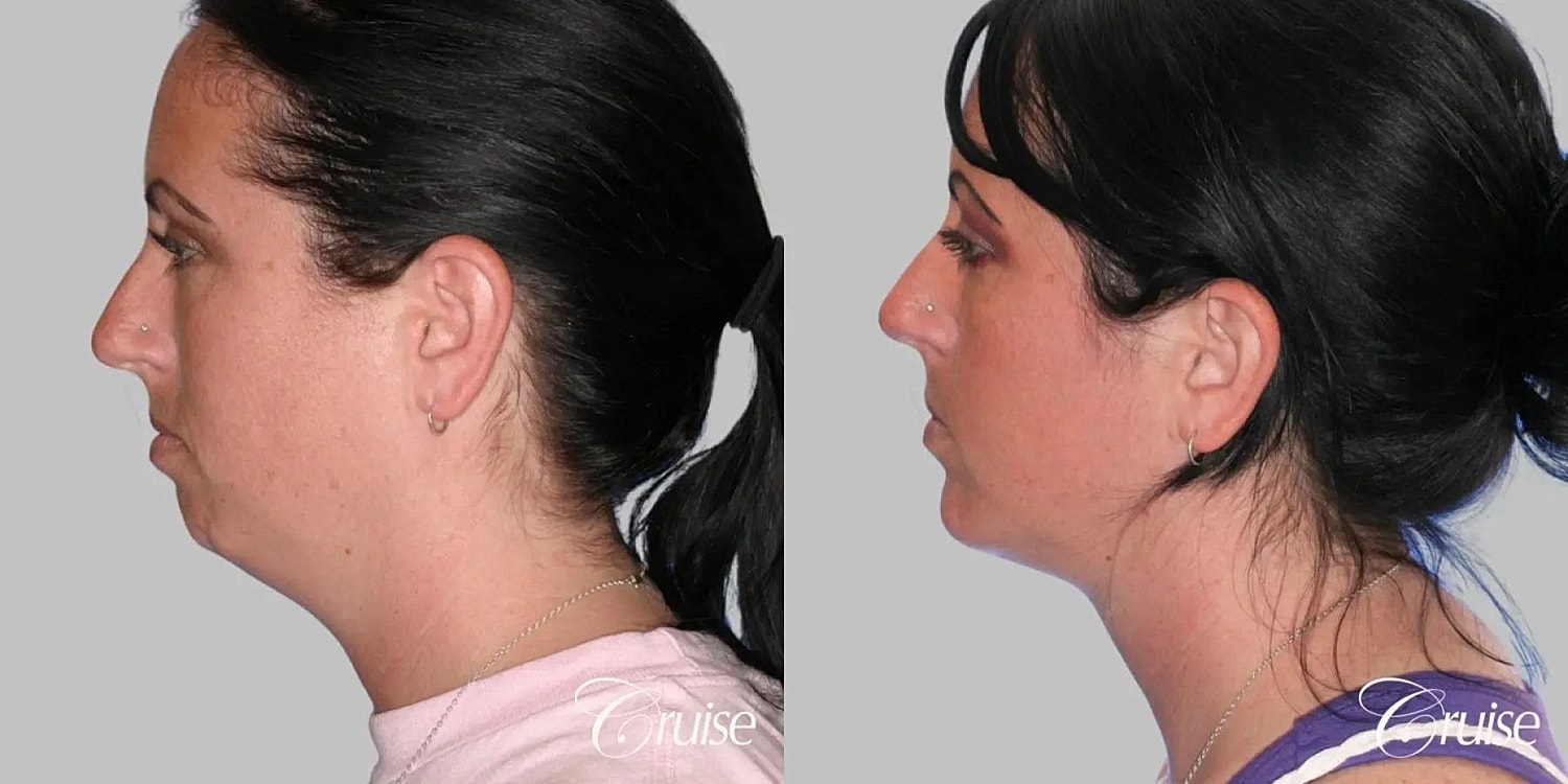 Face Lift Before & After
