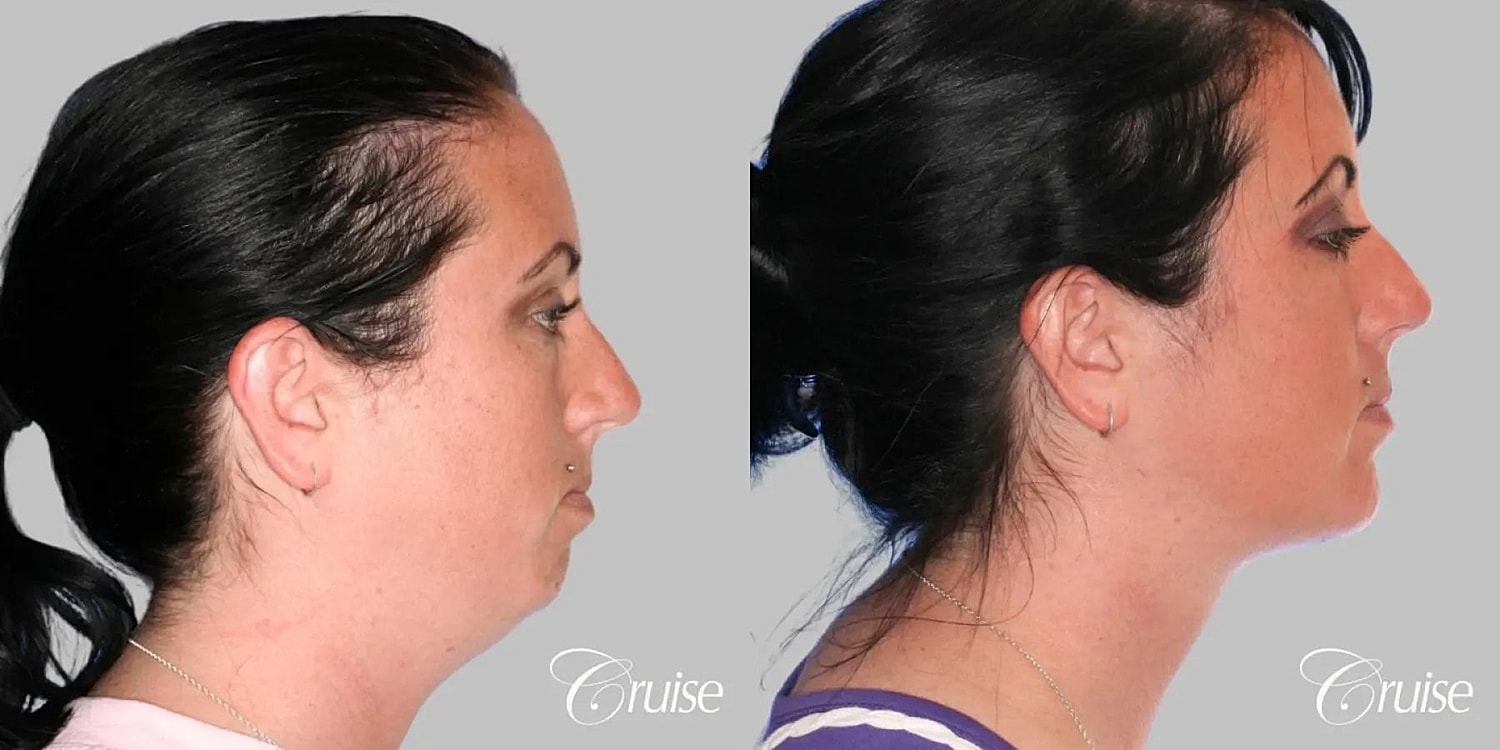 Face Lift Before & After