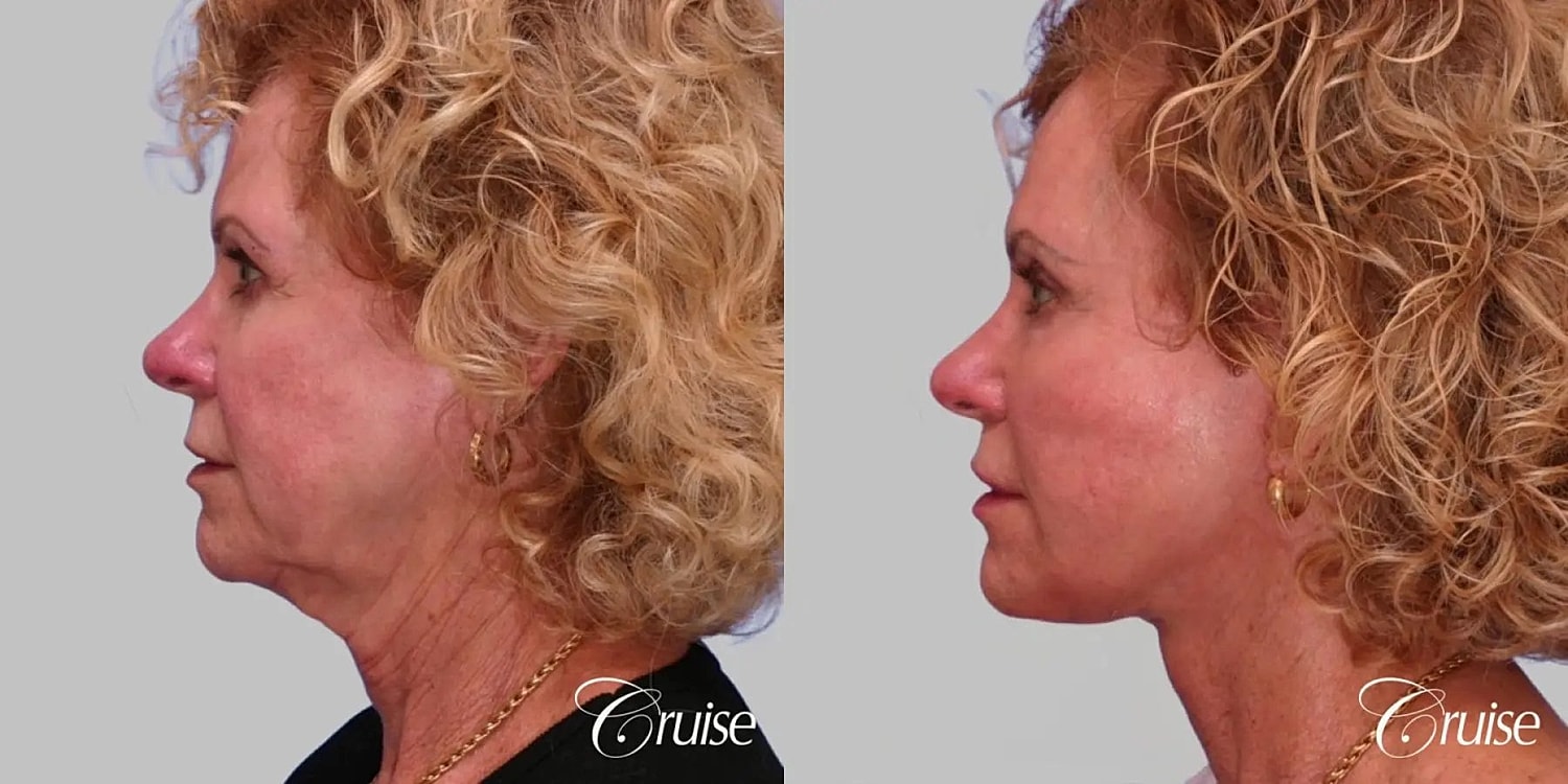 Face Lift Before & After