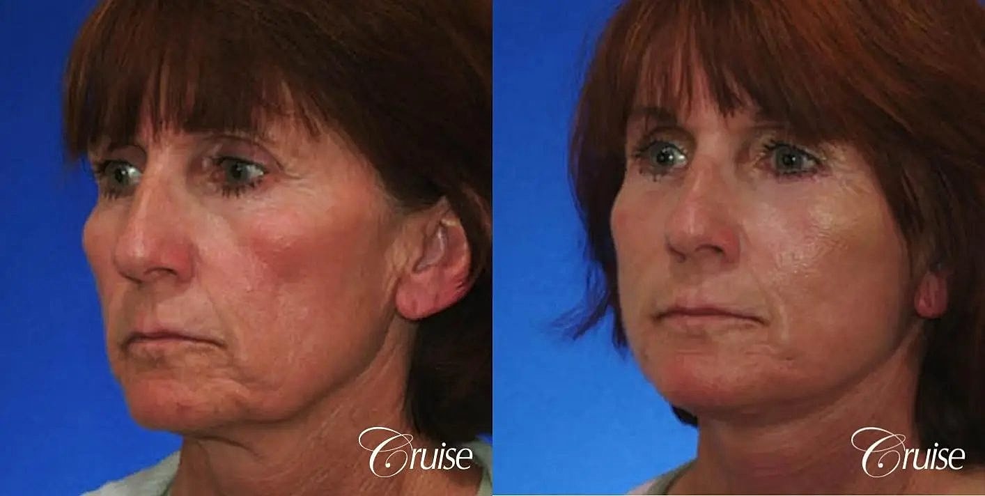 Face Lift Before & After