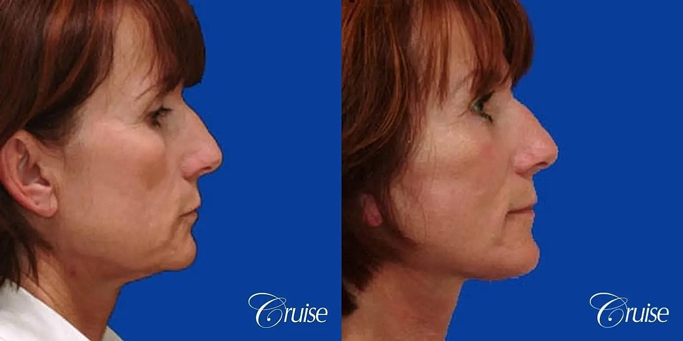 Face Lift Before & After