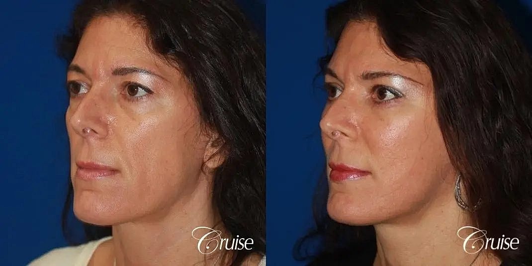 Face Lift Before & After