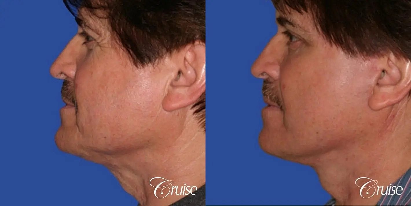 Face Lift Before & After