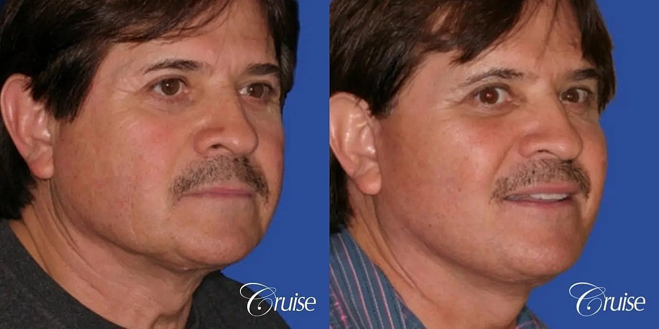Face Lift Before & After