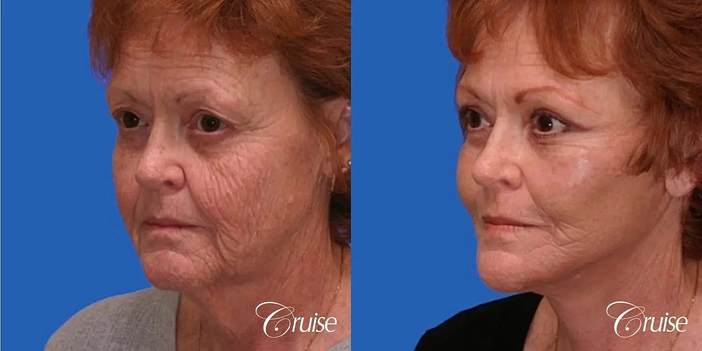 Face Lift Before & After