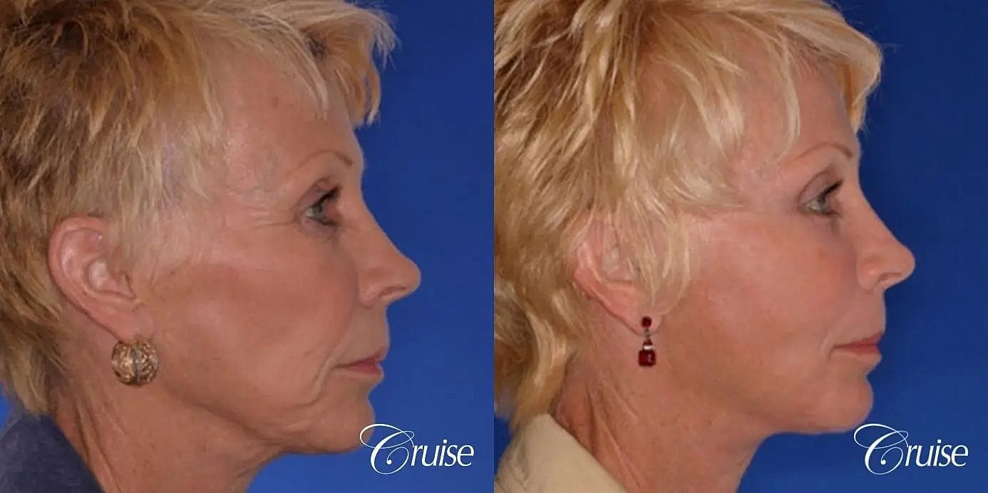 Face Lift Before & After